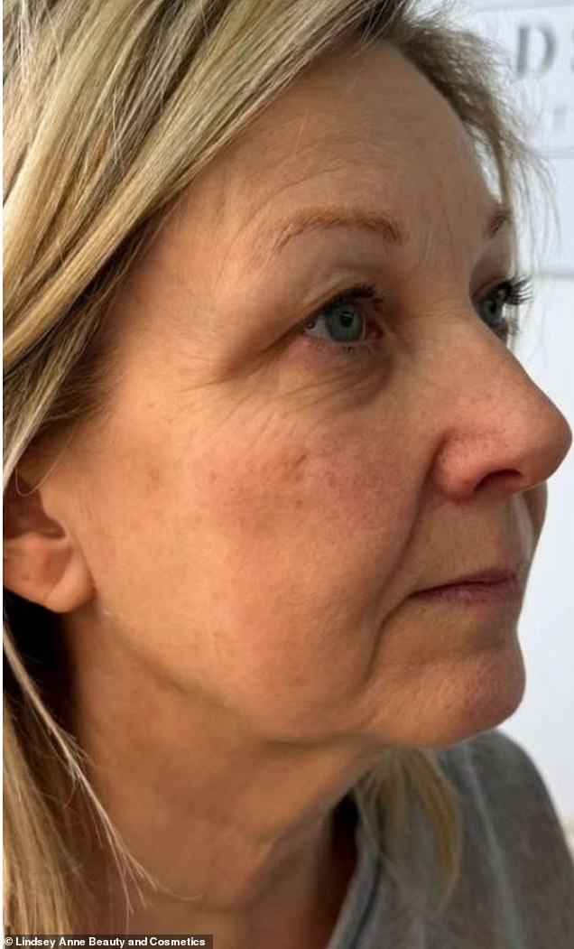Before: A jowl lift at Lindsey Anne Beauty and Cosmetics in Penkridge