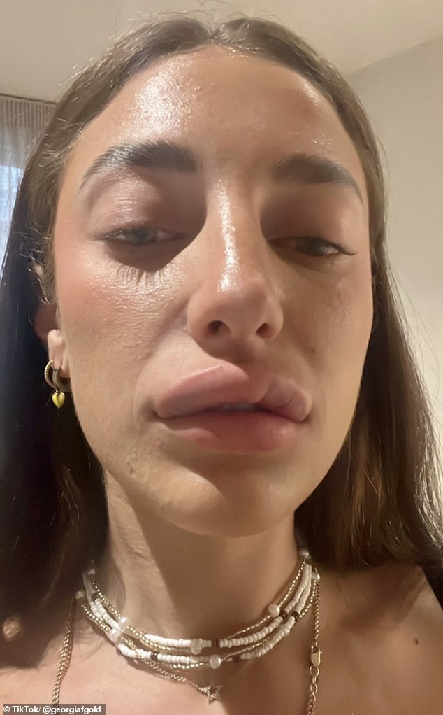 Georgia Goldstein (pictured) from London has revealed what happened when she had her lip filler dissolved - and admitted that she was left looking 'botched'