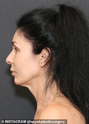 Kelly, 56, before undergoing a series of facial rejuvenation procedures with Dr. Mike Nayak