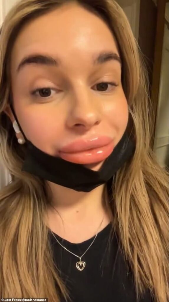 Malene Mauer (pictured) experienced a dramatic and painful reaction when she had lip filler - but the beauty practitioner who carried out the procedure blamed it on her menstrual period