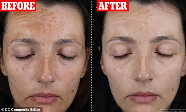 The before and after pictures from the clinical trial of the Skin Rocks Hyperpigmentation Serum