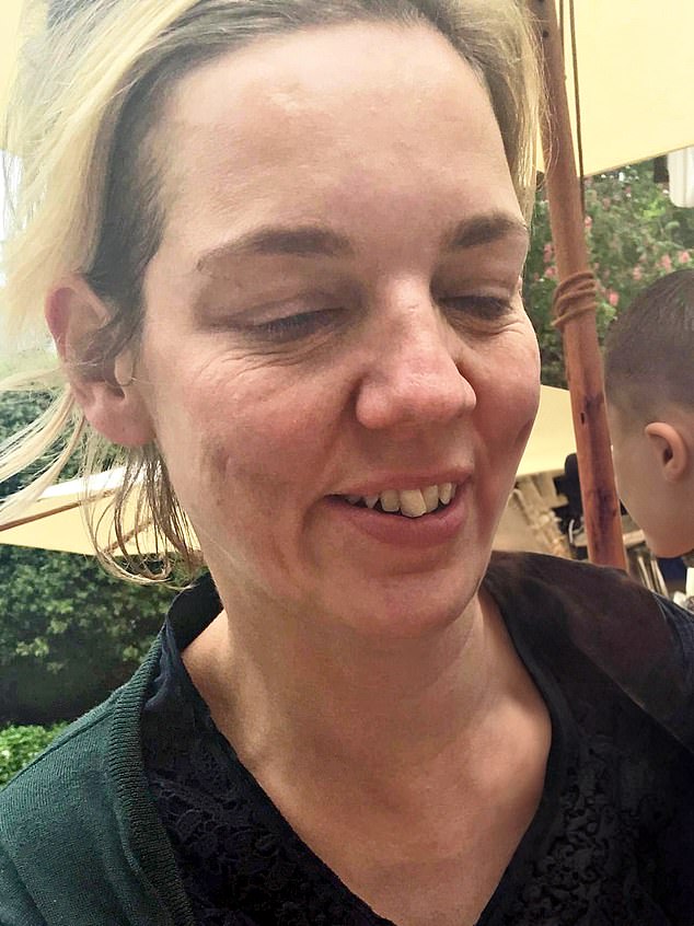 Dr Justine Hextall pictured before she made 11 lifestyle changes that had a dramatic impact on her skin